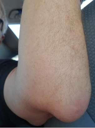 An elbow swollen and inflammed with bursitis